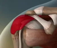 Bursitis