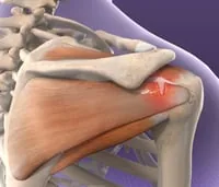 Rotator cuff injuries